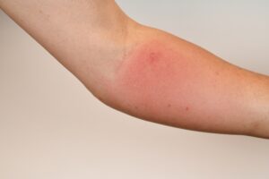 ステロイド副作用での皮膚萎縮の様子