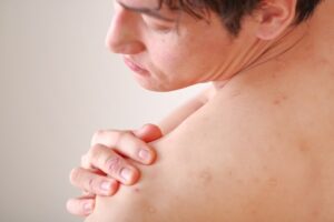 アトピー性皮膚炎での皮膚炎症の様子