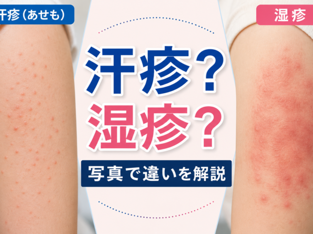汗疹（あせも）と湿疹の違いとは？写真でわかる見分け方と治し方を専門家が解説